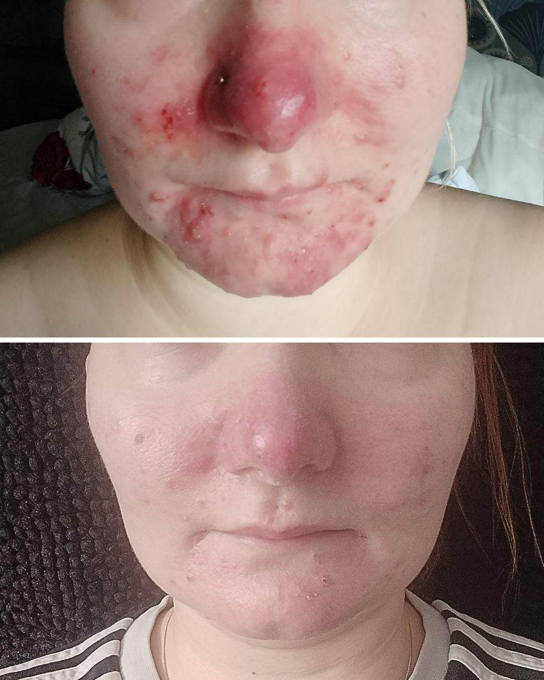 The Nordic Secret to Soothing Redness and Sensitive Skin