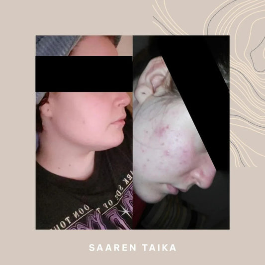 Jojoba & Tea Tree Facial Oil: For Acne-Prone Skin, Natural Effect