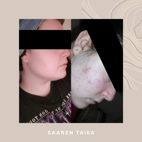 Jojoba & Tea Tree Facial Oil: For Acne-Prone Skin, Natural Effect